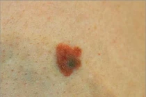 Đàn ông độc thân dễ bị u ác tính