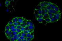 Hình khối u ác tính 3D - tiến bộ y học mới nhất