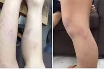 Hà Nội: Kỷ luật cô giáo đánh học sinh tím chân