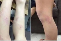 Hà Nội: Kỷ luật cô giáo đánh học sinh tím chân