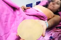 Ca sĩ Ivy Trần vỡ túi nâng ngực: Bác sĩ mổ nói gì? 