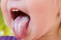 Nấm candida – chữa dứt điểm cần làm gì tại nhà?