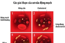 Vì sao người gầy vẫn bị rối loạn mỡ máu? 