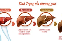 Đối tượng nào dễ mắc bệnh gan nhiễm mỡ?