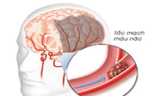 Biến chứng nguy hiểm của huyết áp cao 