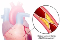 Mối liên hệ giữa bệnh mỡ máu cao và bệnh tim mạch 