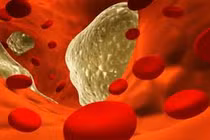 Bệnh máu nhiễm mỡ có nguy hiểm không? 