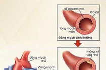 Rối loạn mỡ máu và nguy cơ các bệnh tim mạch