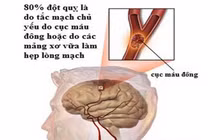 Mỡ trong máu cao có thể gây chết người