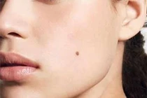 Cực kỳ nguy hiểm khi bị ung thư từ ... nốt ruồi