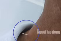 Hãi hùng xương cá đâm xuyên thực quản, lộ ra ngoài da