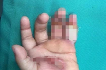 Bé 1 tuổi bị điện giật khiến bàn tay bỏng nặng 
