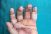 Bé 1 tuổi bị điện giật khiến bàn tay bỏng nặng 