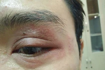 Hàng chục người nhập viện vì dùng tay giết kiến ba khoang