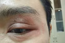 Hàng chục người nhập viện vì dùng tay giết kiến ba khoang