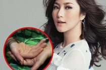 Cách nào để không mắc hội chứng tự lột da tay như Hương Tràm?