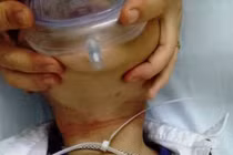 Ngoạn mục cứu sống bé trai bị dây nhựa thít cổ