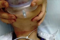 Ngoạn mục cứu sống bé trai bị dây nhựa thít cổ