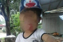 Cháu bé 5 tuổi tử vong khi cắt amidan, nguyên nhân do đâu?