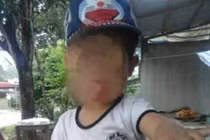 Cháu bé 5 tuổi tử vong khi cắt amidan, nguyên nhân do đâu?