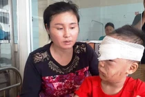Bé trai 6 tuổi ở Thanh Hóa bị chó nhà cắn rách mặt