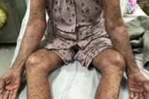 Tự ý dùng thuốc trị gout, cụ bà 83 tuổi nổi phỏng đỏ toàn thân