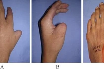 Hy hữu ca phẫu thật đưa ngón chân lên thay thế ngón tay cái