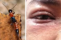 Mắt sưng đỏ, ngứa rát vì dính dịch của kiến ba khoang