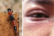 Mắt sưng đỏ, ngứa rát vì dính dịch của kiến ba khoang