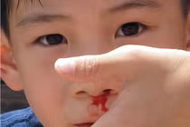 Mẹo làm ngừng chảy máu cam tại nhà hiệu quả