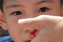 Mẹo làm ngừng chảy máu cam tại nhà hiệu quả