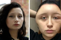 Mặt biến dạng to như quả bóng vì nhuộm tóc