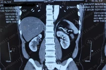 Tá hỏa vì thận ứ nước cứ tưởng đau lưng thông thường