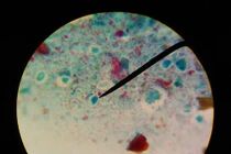 Kinh hãi 2kg sán bám đặc quanh lá gan cô gái trẻ