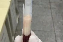 Mắc viêm tụy cấp, người đàn ông có máu đặc như sữa