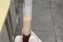 Mắc viêm tụy cấp, người đàn ông có máu đặc như sữa