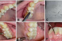 Cô gái 25 tuổi mọc lông ở nướu răng, bác sĩ sửng sốt