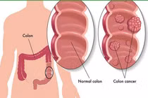 28 tuổi ung thư đại trực tràng vì thói quen nhiều người mắc