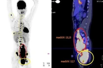 Đau khớp háng, người đàn ông choáng váng phát hiện tế bào ung thư chạy khắp người