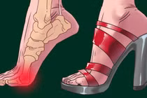 3 bộ phận cơ thể "lâm nguy" khi bạn đi giày cao gót quá nhiều