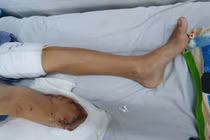 Bác sĩ xót xa cắt bỏ chân bệnh nhi sau 4 lần phẫu thuật không thành công