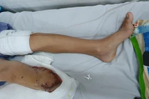 Bác sĩ xót xa cắt bỏ chân bệnh nhi sau 4 lần phẫu thuật không thành công