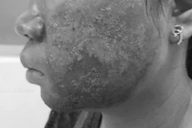 Da mặt nhiễm trùng, mưng mủ sau khi lăn kim tại spa