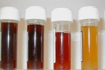 Bắt bệnh nhanh qua màu nước tiểu