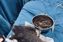 Quảng Ngãi: Bé gái 12 tuổi "ăn" gần 1kg tóc, lấp kín dạ dày