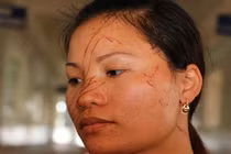 Gia Lai: Hai mẹ con bị hàng xóm rạch mặt dã man