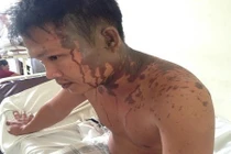 20 côn đồ xông vào nhà tạt axit rồi vứt lại 3 ngón tay