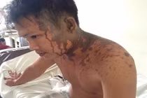 20 côn đồ xông vào nhà tạt axit rồi vứt lại 3 ngón tay