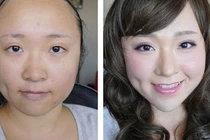 Nâng sống mũi bằng bột mỳ, độc chiêu làm đẹp gây sốt