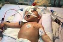 Bé trai 11 ngày tuổi bị đâm xuyên đầu có thể đột tử